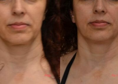 Face rejuvenation by radiofrequency, focusing on eyes, face and neck shape, Dana Clinic, Prague 9, Try it and see the result right away.