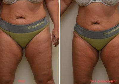 Painless liposuction, abdominal and hip slimming, after 2 treatments, 4 cm loss, Dana Clinic, Prague 9,