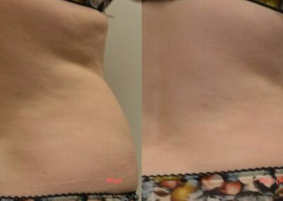 Painless liposuction, weight loss of back and hips after three treatments, 3 cm loss, Dana Clinic, Prague 9, Try it.