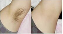 Diode laser hair removal after 5 treatments, Prague 9,