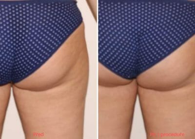 Slim up cellulite removal in Prague, 1 treatment, Dana Clinic, Book now.