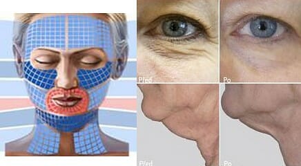 Neinvazivní anti-aging, ošetřované části obličeje a výsledky před a po. Praha, Dana Clinic