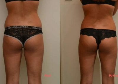 Vorher und nachher Fettabsaugung und Faltenbehandlung ohne OP, 6 Verfahren, Verlust 7cm, Prag 9, Dana Clinic
