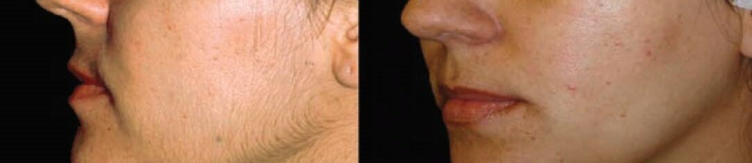 Trvalá epilace těla diodovým laserem, tvář před a po, Dana Clinic, Praha 9