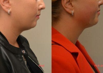 Radiofrequency liposuction Exilis, Non-invasive liposuction without surgery of face and neck, Dana Clinic.