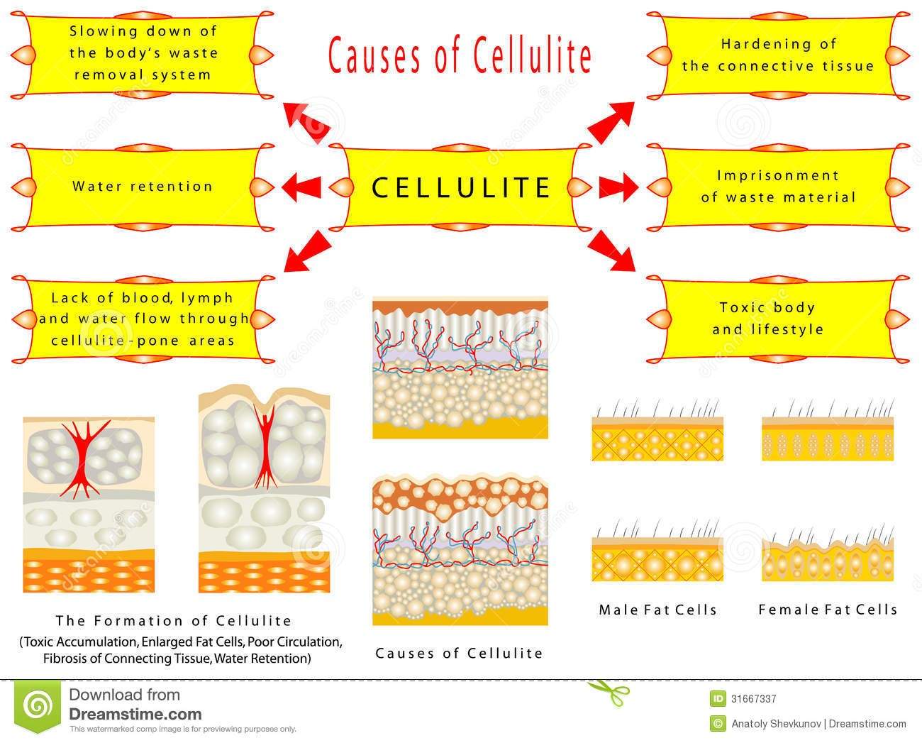 Bild mit Ursachen von Cellulite, Prag 9, Dana Clinic, Anti-Cellulite Behandlungen.