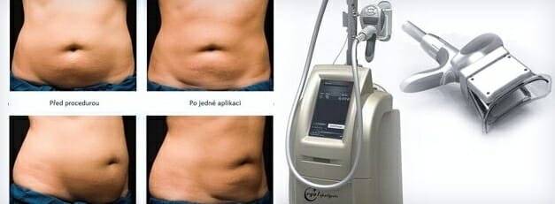 Kryolipolýza zmražení tukových buněk, klientka před a po různých procedurách, hubnutí trvalo rok,  Dana Clinic, Praha 9