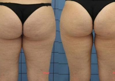 Klientka před a po, 6 ošetření. Odstranění tuku a celulitdy, Dana Clinic, Praha