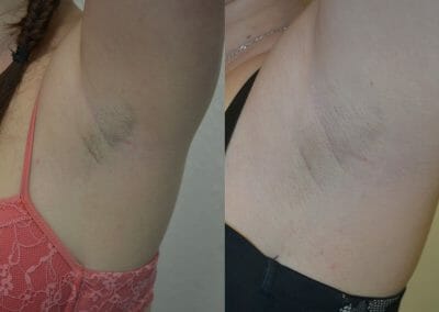 BTL Exilite - redukce chloupků v podpaží, foto před a po, Clinic Dana, Praha 9