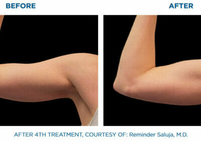 Arm - EMSCULPT - build muscle, fat reduction, Beauty studio Dana, Prague 9, BOOK NOW