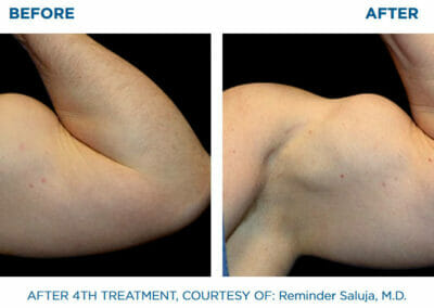 Arm - EMSCULPT - build muscle, fat reduction, Beauty studio Dana, Prague 9, BOOK NOW