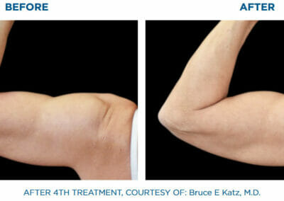 Arm - EMSCULPT - build muscle, fat reduction, Beauty studio Dana, Prague 9, BUCHEN SIE JETZT