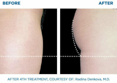 Buttocks - EMSCULPT - build muscle, fat reduction, Beauty studio Dana, Prague 9, BOOK NOW